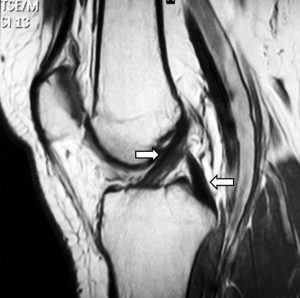 Evidence-based clinical practice update: practice guidelines for ACL rehabilitation based on a systematic review Evidence-based clinical practice update: practice guidelines for ACL rehabilitation based on a systematic review
