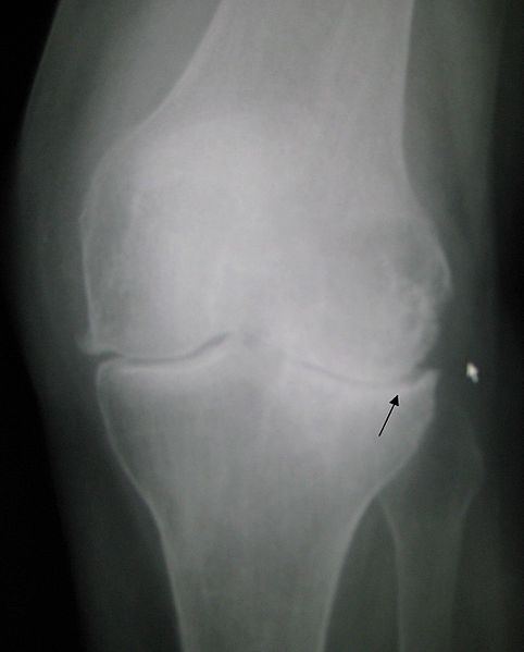 Pain sensitization in people with knee osteoarthritis Pain sensitization in people with knee osteoarthritis