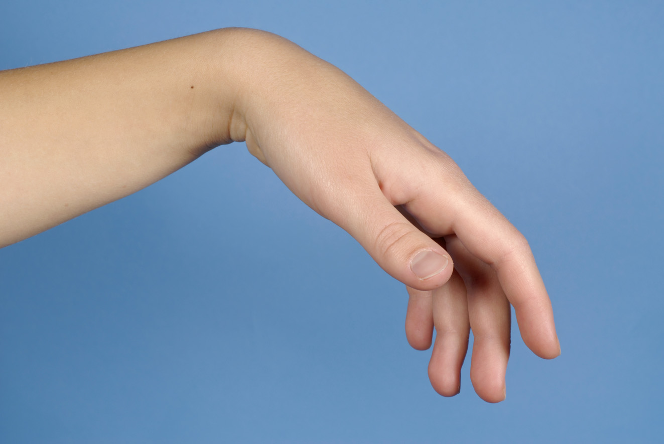 Tenodese_hand.jpg
