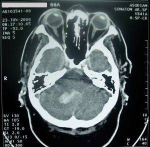 No changes in functional connectivity during motor recovery beyond 5 weeks post-stroke. A resting-state fMRI study. No changes in functional connectivity during motor recovery beyond 5 weeks post-stroke. A resting-state fMRI study.