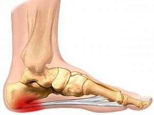 Plantar Fasciopathy Infographic and Podcasts! Plantar Fasciopathy Infographic and Podcasts!