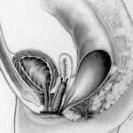 Rectovestibular_fistula_in_females