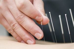 Contribution of Dry Needling to Individualized Physical Therapy Treatment of Shoulder Pain Contribution of Dry Needling to Individualized Physical Therapy Treatment of Shoulder Pain