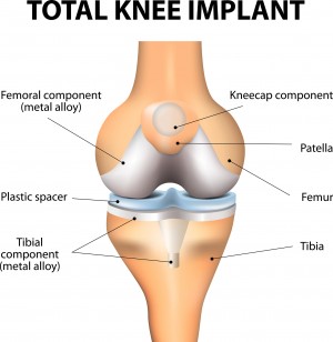The effects of total knee replacement and non-surgical treatment on pain sensitization and clinical pain. The effects of total knee replacement and non-surgical treatment on pain sensitization and clinical pain.