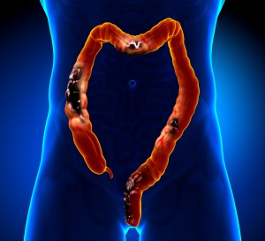 An increase in physical activity after colorectal cancer surgery is associated with improved recovery of function An increase in physical activity after colorectal cancer surgery is associated with improved recovery of function