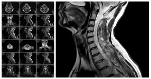 The reliability of the cervical relocation test on people with and without a history of neck pain The reliability of the cervical relocation test on people with and without a history of neck pain