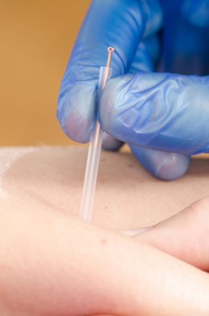 Exercises and Dry Needling for Subacromial Pain Syndrome: A Randomized Parallel-Group Trial. Exercises and Dry Needling for Subacromial Pain Syndrome: A Randomized Parallel-Group Trial.