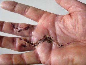 Open Access Article: Post-surgical scar assessment in rehabilitation: a systematic review Open Access Article: Post-surgical scar assessment in rehabilitation: a systematic review