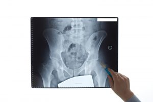 Personalised Hip Therapy: development of a non-operative protocol to treat femoroacetabular impingement syndrome in the FASHIoN randomised controlled trial. Personalised Hip Therapy: development of a non-operative protocol to treat femoroacetabular impingement syndrome in the FASHIoN randomised controlled trial.