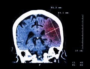 NEW Stroke Course Update NEW Stroke Course Update