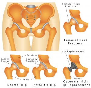 A critical review of the long-term disability outcomes following hip fracture. A critical review of the long-term disability outcomes following hip fracture.