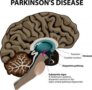 Virtual reality for rehabilitation in Parkinson's disease. Virtual reality for rehabilitation in Parkinson's disease.