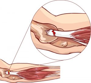 Economic evaluation favours physio but not steroid injection as a first-line intervention for chronic tennis elbow Economic evaluation favours physio but not steroid injection as a first-line intervention for chronic tennis elbow