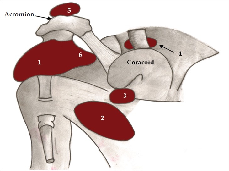Exercise therapy for treatment of shoulder impingement syndrome? Exercise therapy for treatment of shoulder impingement syndrome?
