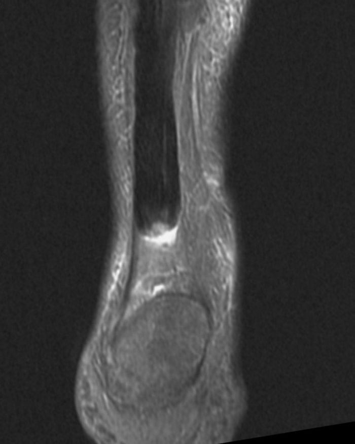 What is the best clinical test for Achilles tendinopathy? What is the best clinical test for Achilles tendinopathy?