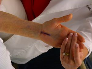 Is there a relationship between impaired median nerve excursion and carpal tunnel syndrome? A systematic review. Is there a relationship between impaired median nerve excursion and carpal tunnel syndrome? A systematic review.