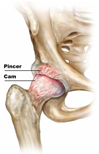 Which is the most useful patient-reported outcome in femoroacetabular impingement? Which is the most useful patient-reported outcome in femoroacetabular impingement?