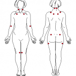 Fibromyalgia 1990 ACR Criteria