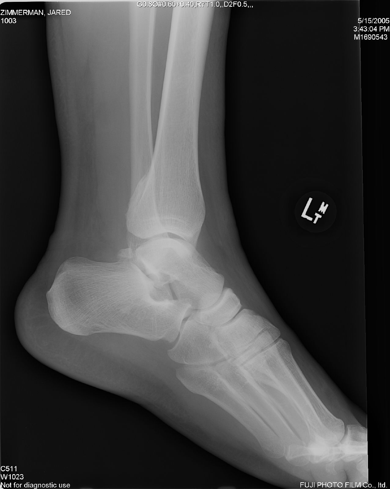 Immediate effect of a single anteroposterior talus mobilization on dorsiflexion range of motion in participants with orthopedic dysfunction of the ankle and foot. Immediate effect of a single anteroposterior talus mobilization on dorsiflexion range of motion in participants with orthopedic dysfunction of the ankle and foot.