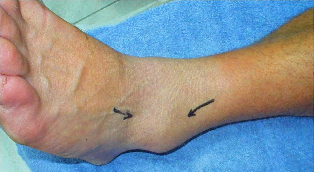 Prognosis Of Ankle Syndesmosis Injury Physiospot Physiotherapy And 