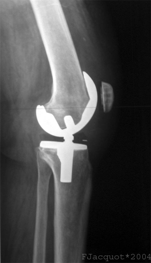 Home-Based versus Hospital-Based Rehabilitation Program after Total Knee Replacement Home-Based versus Hospital-Based Rehabilitation Program after Total Knee Replacement
