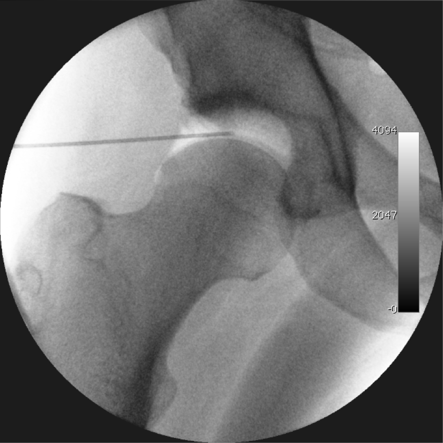 Manual Therapy for Hip Osteoarthritis: A Systematic Review and Meta-analysis Manual Therapy for Hip Osteoarthritis: A Systematic Review and Meta-analysis