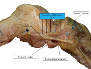Surgeons Describe New Ligament in the Knee with Implications for ACL Injuries Surgeons Describe New Ligament in the Knee with Implications for ACL Injuries