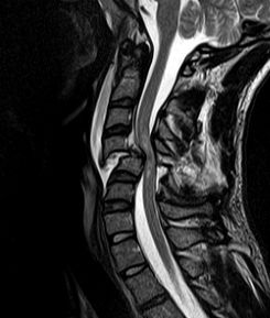 Physiotherapy Commenced Within the First Four Weeks Post-Spinal Surgery Is Safe and Effective: A Systematic Review and Meta-Analysis. Physiotherapy Commenced Within the First Four Weeks Post-Spinal Surgery Is Safe and Effective: A Systematic Review and Meta-Analysis.