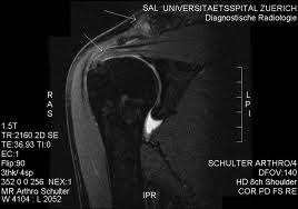Short-Term Effectiveness of Precut Kinesiology Tape Versus an NSAID as Adjuvant Treatment to Exercise for Subacromial Impingemen Short-Term Effectiveness of Precut Kinesiology Tape Versus an NSAID as Adjuvant Treatment to Exercise for Subacromial Impingemen