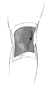 Exercise, education, manual-therapy and taping compared to education for patellofemoral osteoarthritis Exercise, education, manual-therapy and taping compared to education for patellofemoral osteoarthritis