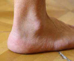 Dynamic balance deficits in individuals with chronic ankle instability Dynamic balance deficits in individuals with chronic ankle instability