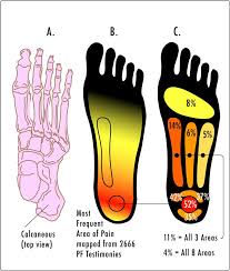 The effect of additional ankle and midfoot mobilizations on plantar fasciitis The effect of additional ankle and midfoot mobilizations on plantar fasciitis