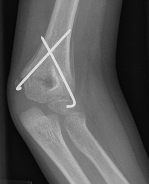 grading supracondylar fracture grading supracondylar fracture
