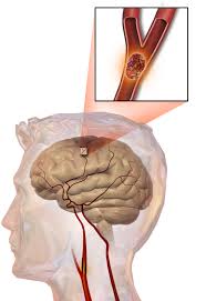 Implementation of a Community-Based Triage for Patients with Suspected Transient Ischemic Attack or Minor Stroke Study: A Prospective Multicenter Observational Study. Implementation of a Community-Based Triage for Patients with Suspected Transient Ischemic Attack or Minor Stroke Study: A Prospective Multicenter Observational Study.