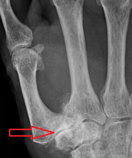 Investigation of the effect of conservative interventions in thumb carpometacarpal osteoarthritis Investigation of the effect of conservative interventions in thumb carpometacarpal osteoarthritis