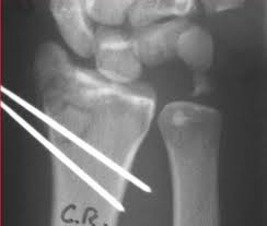 Intra-articular Radial Head Fractures In the Skeletally Immature Patient Intra-articular Radial Head Fractures In the Skeletally Immature Patient