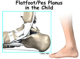 Pes planus and paediatric obesity Pes planus and paediatric obesity