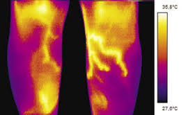 Infrared thermography is useful for ruling out fractures in paediatric emergencies Infrared thermography is useful for ruling out fractures in paediatric emergencies