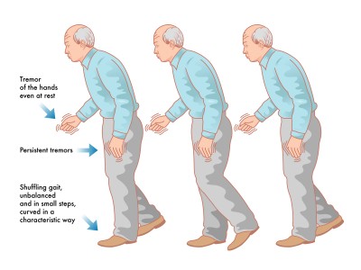 "Cueing" for Levodopa-Induced Dyskinesias in Parkinson's Disease. "Cueing" for Levodopa-Induced Dyskinesias in Parkinson's Disease.