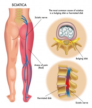Does cervical spine manipulation reduce pain in people with degenerative cervical radiculopathy? A systematic review of the evidence, and a meta-analysis. Does cervical spine manipulation reduce pain in people with degenerative cervical radiculopathy? A systematic review of the evidence, and a meta-analysis.