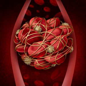 Prevention of the Post-Thrombotic Syndrome. Prevention of the Post-Thrombotic Syndrome.