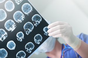Neural correlates of motor recovery after robot-assisted stroke rehabilitation: a case series study. Neural correlates of motor recovery after robot-assisted stroke rehabilitation: a case series study.