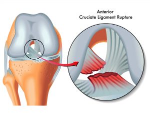 The effectiveness of pre-op exercise rehabilitation on outcomes of treatment following ACL injury a systematic review. The effectiveness of pre-op exercise rehabilitation on outcomes of treatment following ACL injury a systematic review.