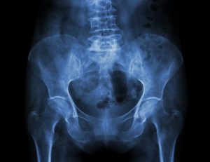 Risk factors for pelvic insufficiency fractures and outcome after conservative therapy. Risk factors for pelvic insufficiency fractures and outcome after conservative therapy.