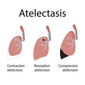atelectasis physiospot illustration vector preview