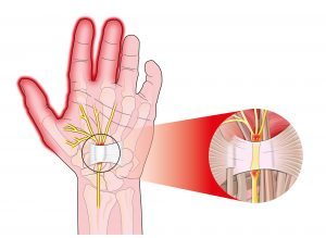 Effectiveness of Nerve Gliding Exercises on Carpal Tunnel Syndrome: A Systematic Review. Effectiveness of Nerve Gliding Exercises on Carpal Tunnel Syndrome: A Systematic Review.