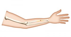 Non-operative management of distal humerus fractures in the elderly: a review of functional outcomes. Non-operative management of distal humerus fractures in the elderly: a review of functional outcomes.