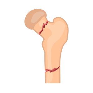 Effectiveness of acute inpatient PT with quad strength training in reducing strength deficits post hip fracture Effectiveness of acute inpatient PT with quad strength training in reducing strength deficits post hip fracture
