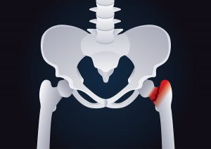 Efficacy of adding a physiotherapy rehabilitation programme to arthroscopic management of femoroacetabular impingement Efficacy of adding a physiotherapy rehabilitation programme to arthroscopic management of femoroacetabular impingement