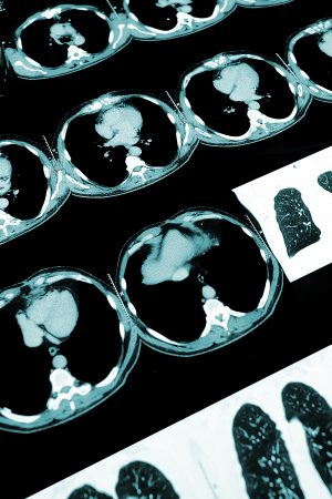 Air trapping in early cystic fibrosis lung disease-Does CT tell the full story? Air trapping in early cystic fibrosis lung disease-Does CT tell the full story?